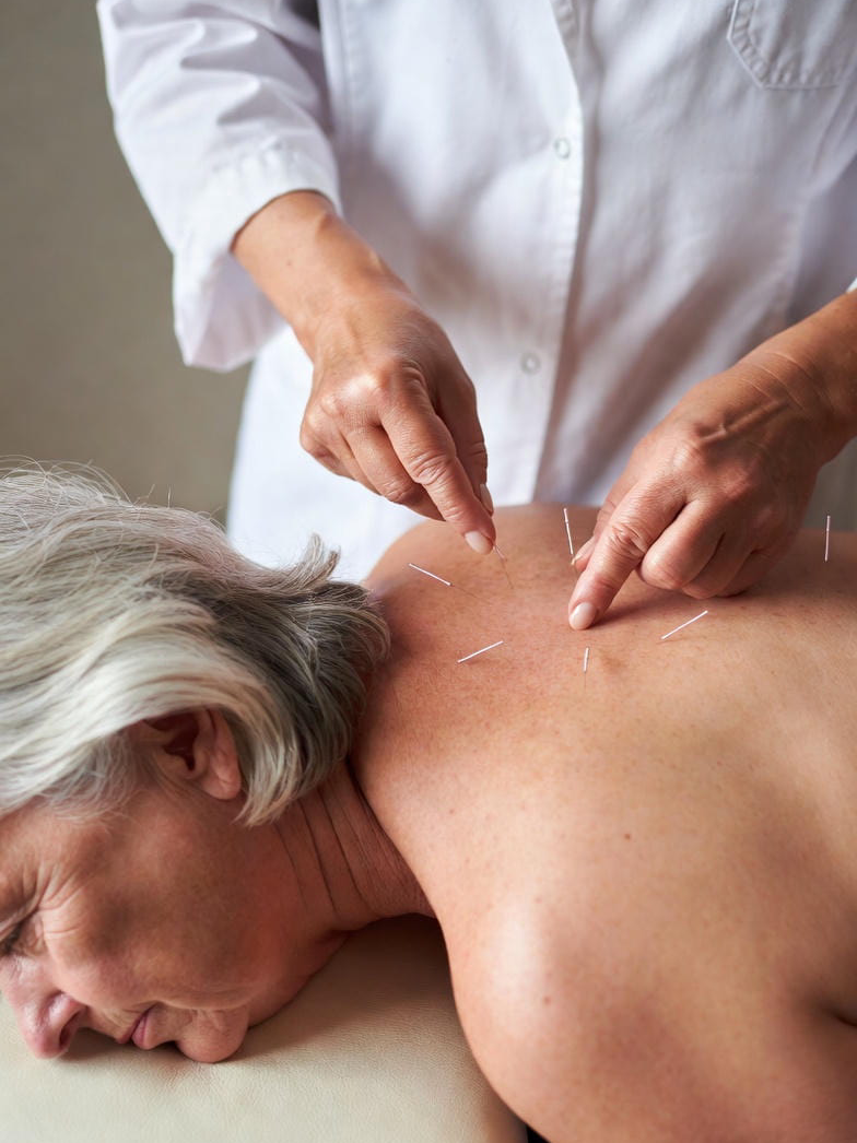 Acupuncture